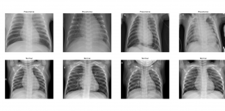 Transfert Learning : Aide au diagnostic de la pneumonie