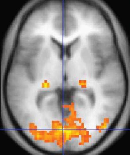 Imagerie à Résonance Magnétique fonctionnelle, montrant les zones du cerveau activées. Cerveau droit versus gauche.